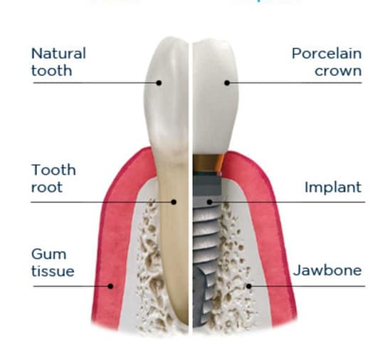 implant dentar ieftin