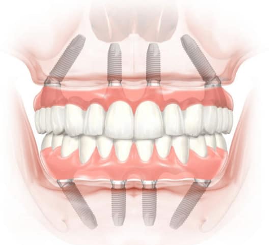 implant dentar ieftin