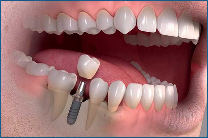 implantul dentar