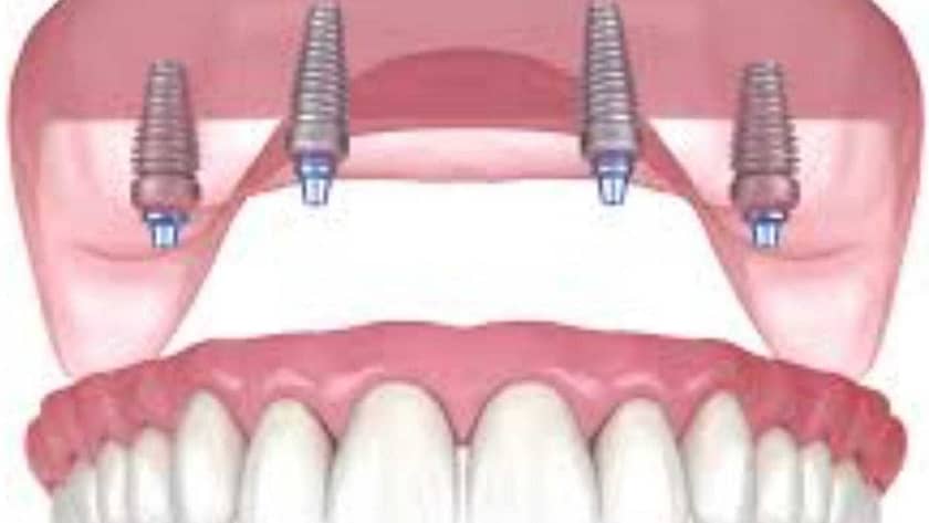 implant dentar ieftin