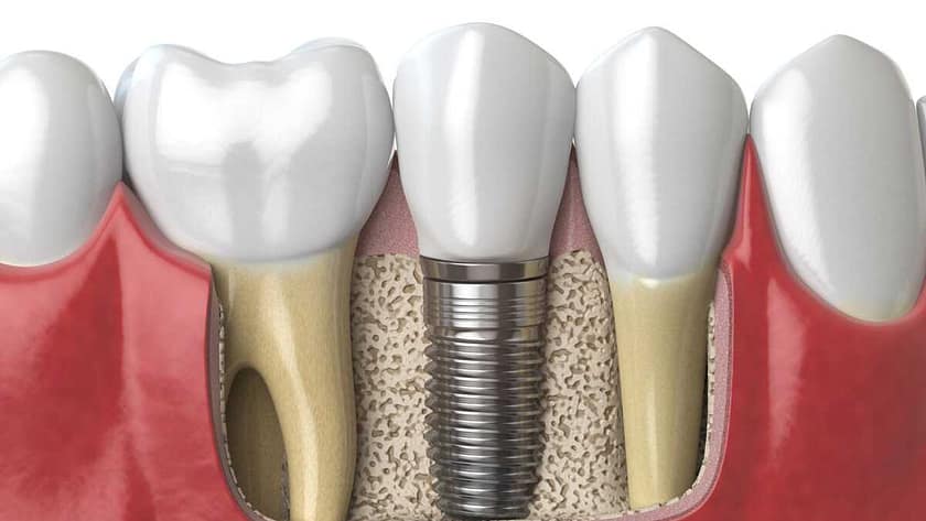 implant dentar
